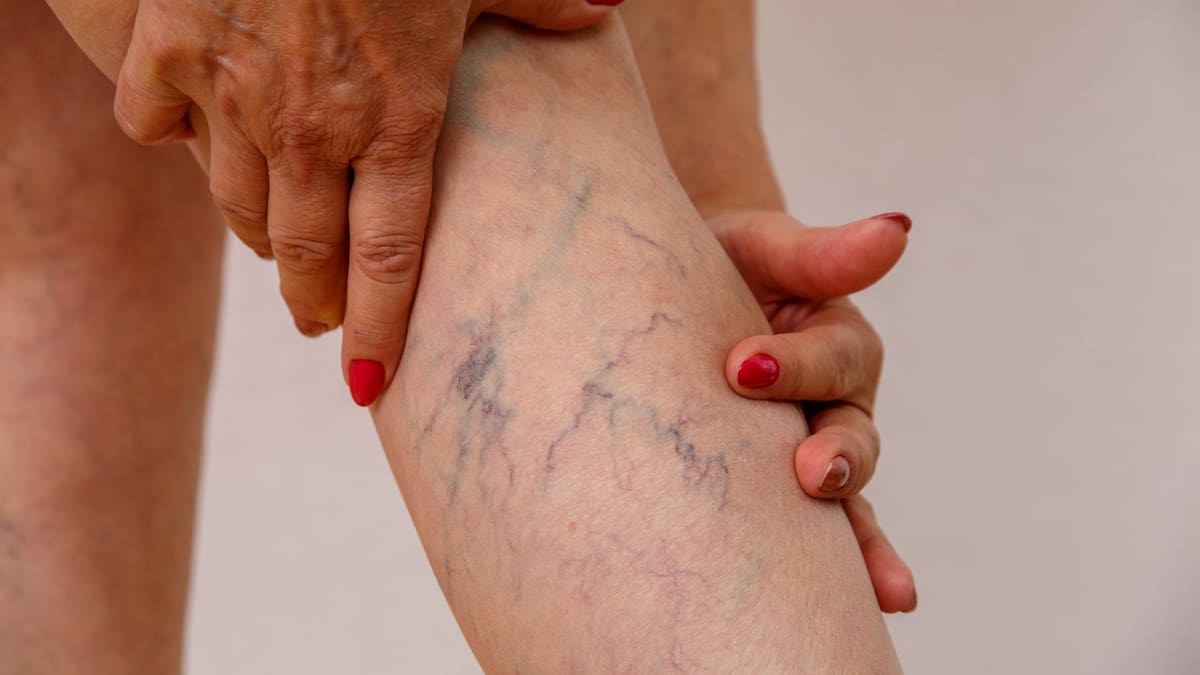 ¿Cuáles son los riesgos de no tratar a tiempo las venas várices? Médico explicó