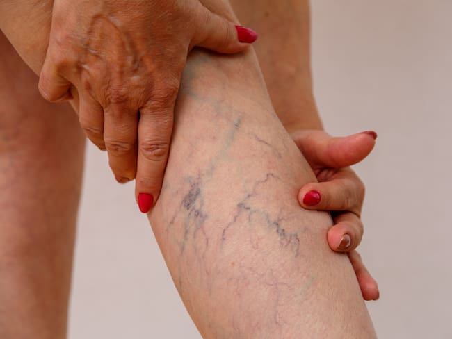 ¿Cuáles son los riesgos de no tratar a tiempo las venas várices? Médico explicó