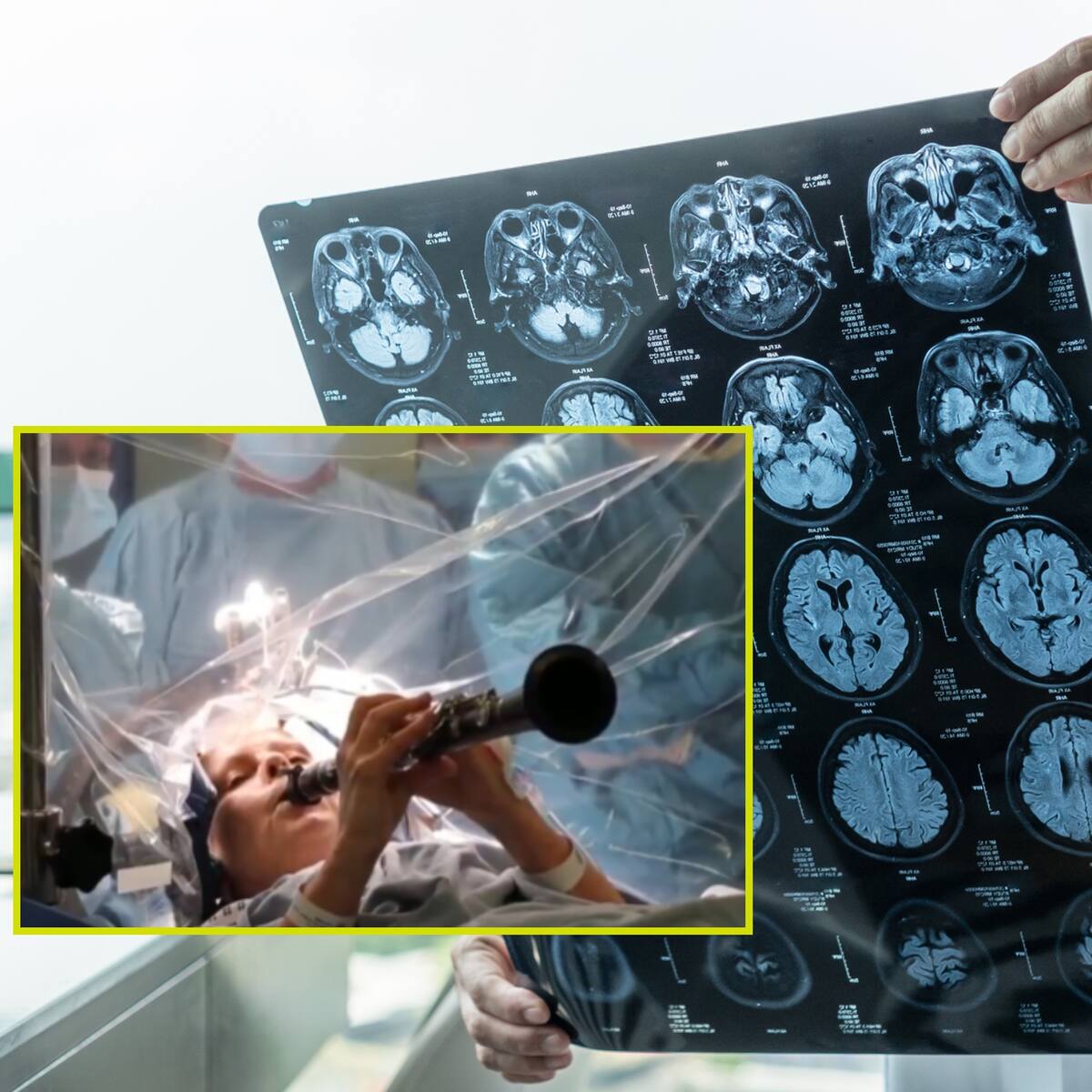 Paciente con párkison tocó clarinete durante operación de cerebro: así fue el procedimiento