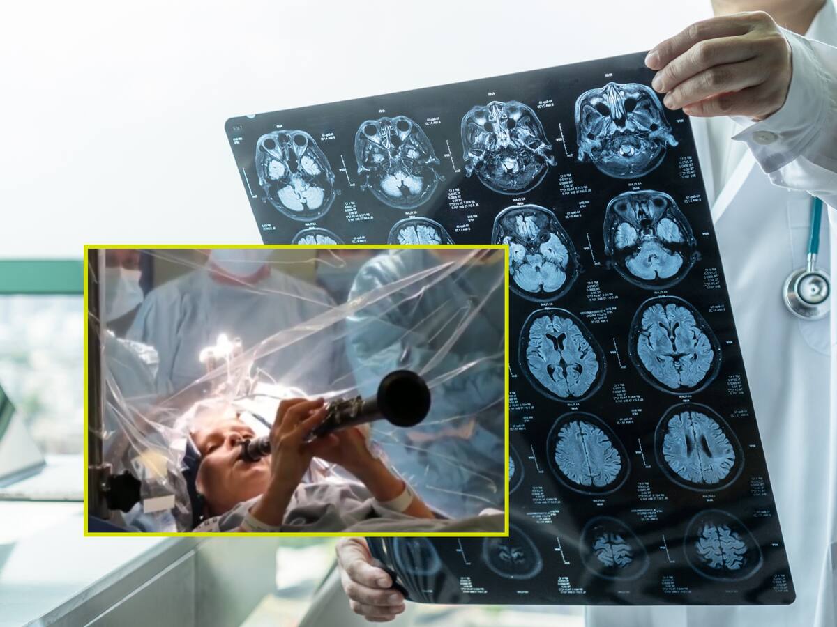 Paciente con párkison tocó clarinete durante operación de cerebro: así fue el procedimiento