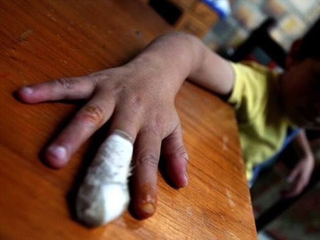 Hasta el momento se han registrado 199 personas quemadas con pólvora durante diciembre en el país. Foto: Colprensa