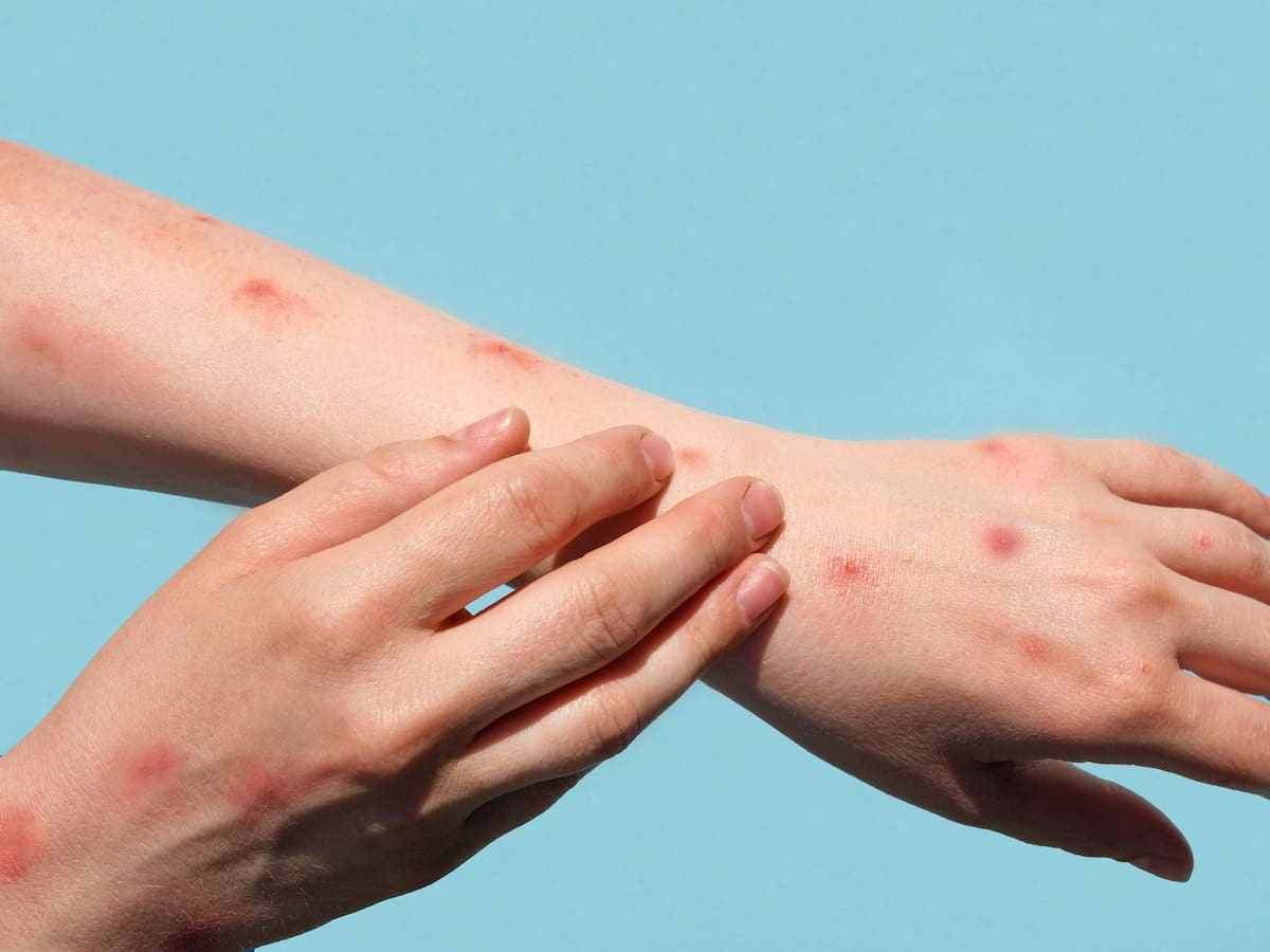 Viruela del mono: así se prepara Córdoba para hacerle frente a la emergencia