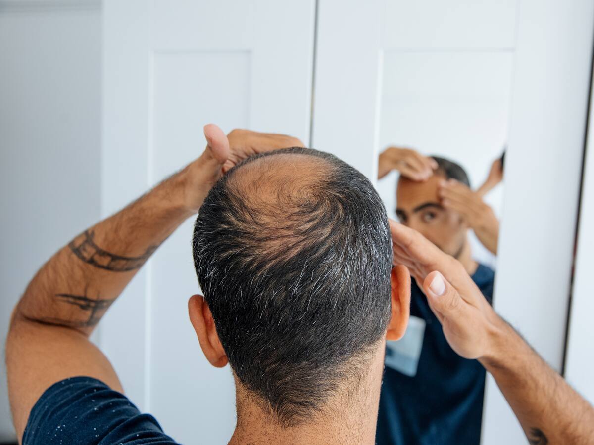 ¿Tratamientos para regenerar el pelo en personas calvas son efectivos? Experta habla de la alopecia