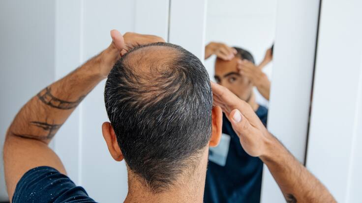 ¿Tratamientos para regenerar el pelo en personas calvas son efectivos? Experta habla de la alopecia