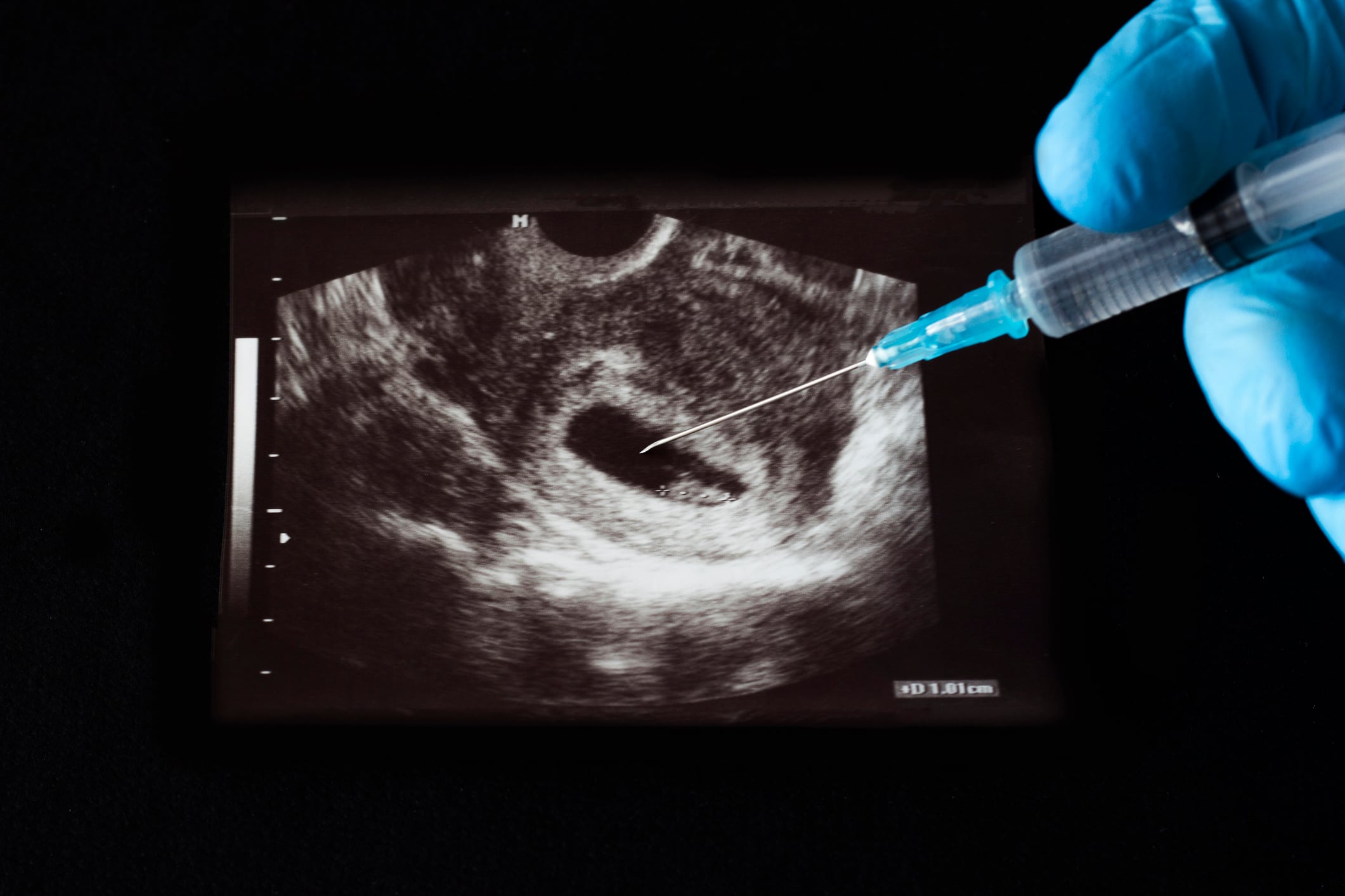 Imagen de referencia de aborto. foto: Getty Images.