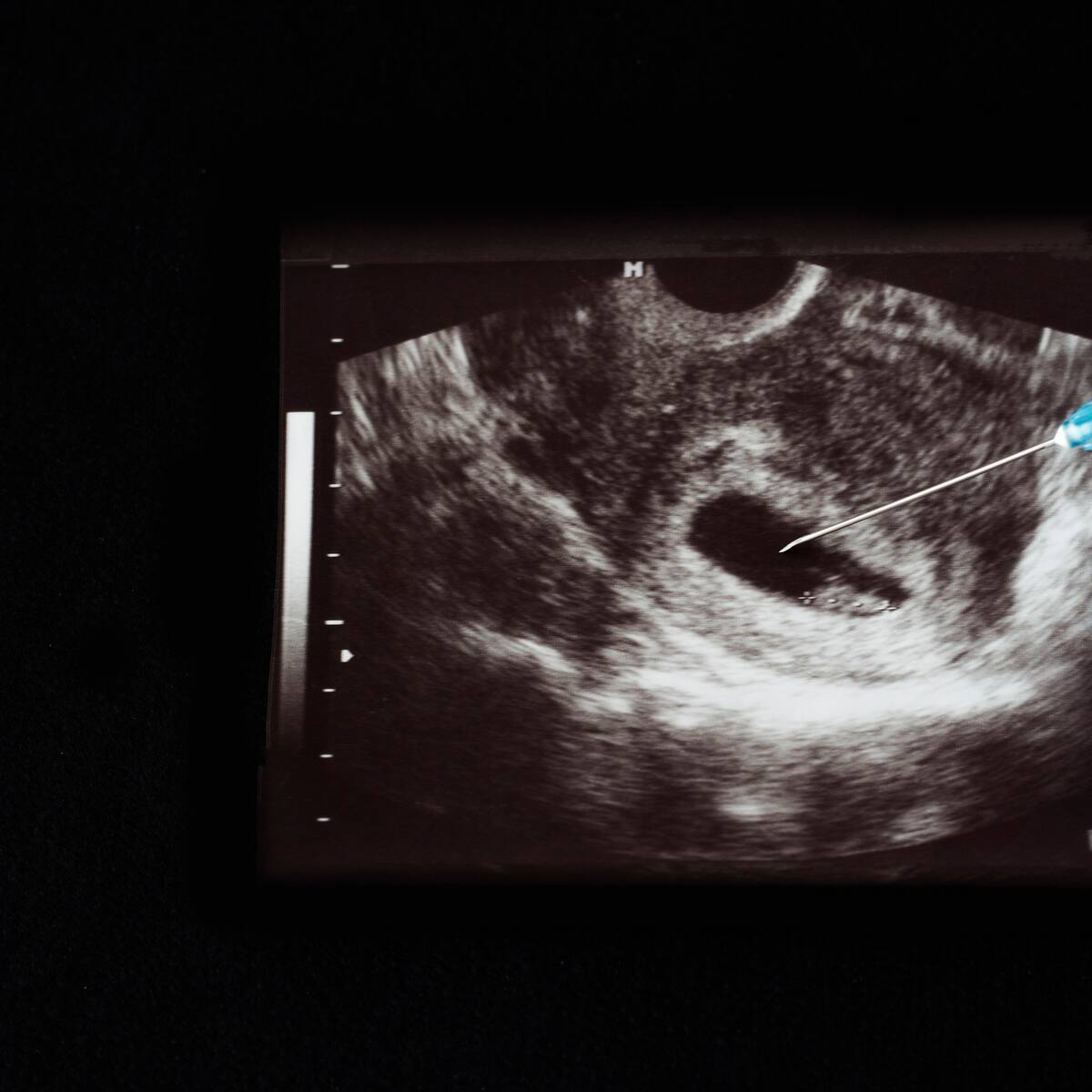 Corte Constitucional volverá a discutir sobre el aborto: así va el debate