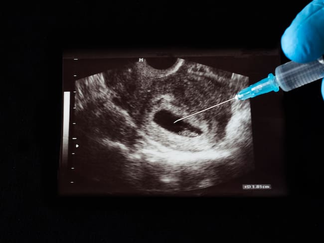 Imagen de referencia de aborto. foto: Getty Images.