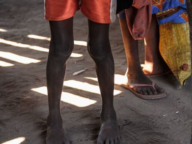 Desnutrición en niños. Créditos: Getty Images