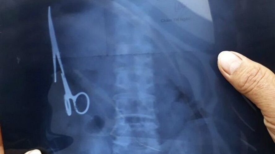 Un ultrasonido mostró que Ma Van Nhat vivía con una tijera en el estómago.. Foto: BBC Mundo