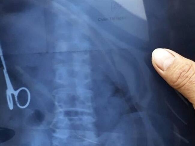 Un ultrasonido mostró que Ma Van Nhat vivía con una tijera en el estómago.. Foto: BBC Mundo