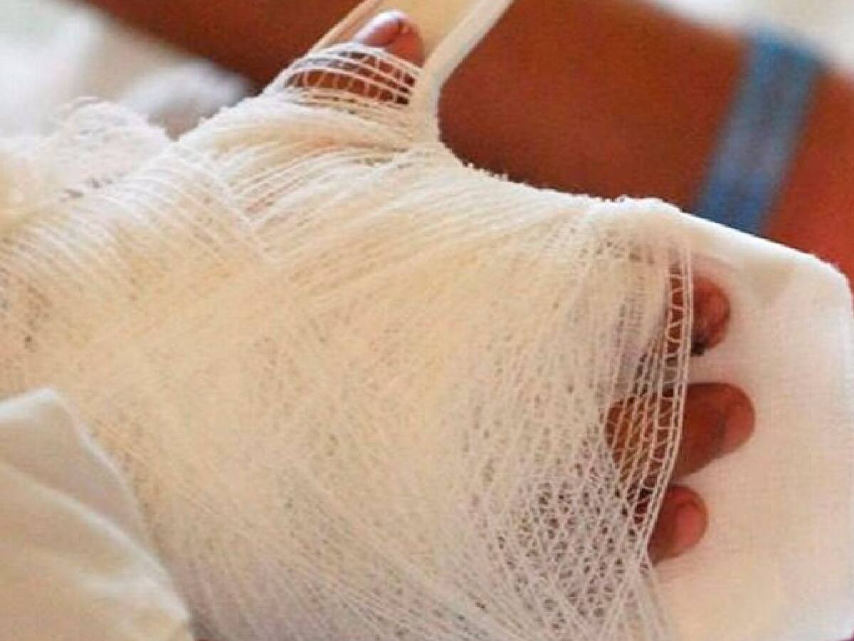 A nueve aumentaron los quemados por pólvora en Santander