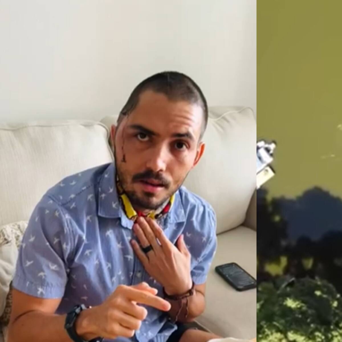 Me fracturó la mandíbula en 4 partes: colombiano que sobrevivió a ataque de caimán