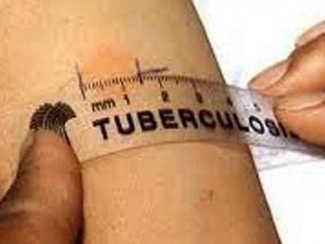 Aumentan casos de tuberculosis en cárcel de hombres de Pereira / Foto: Colprensa