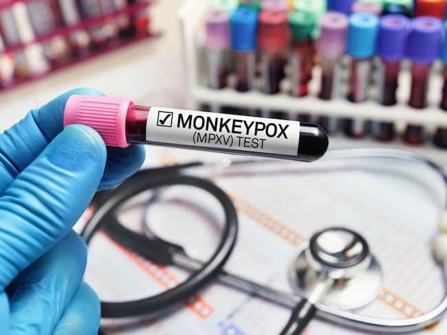 Resultado positivo de viruela del mono. Imagen de referencia. Foto: Getty Images