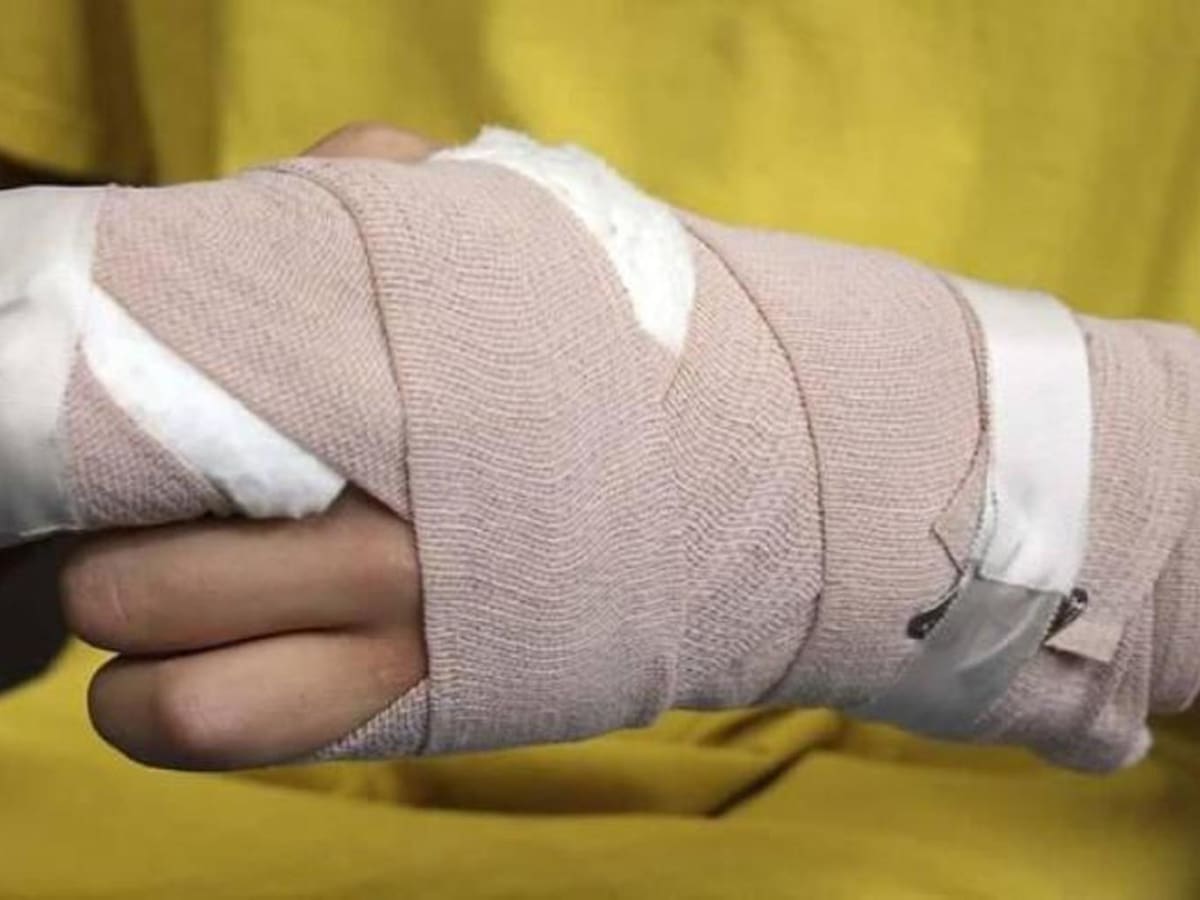 Menor de siete años, el primer quemado con pólvora en Norte de Santander en 2025