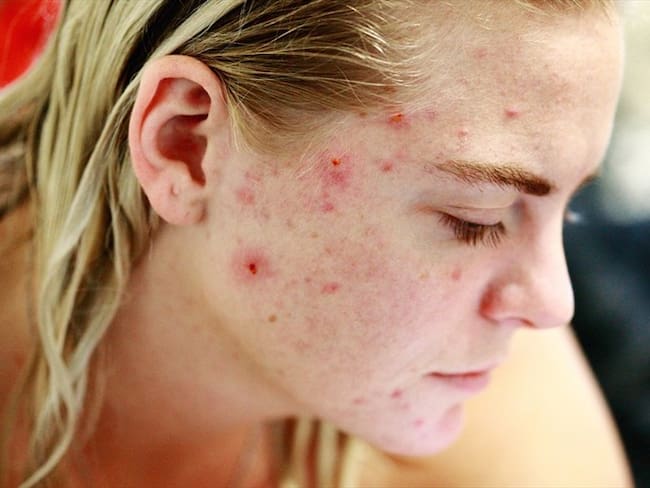 Exprimir granos o espinillas entre parejas fortalece la relación, según estudio. Foto: Pixabay