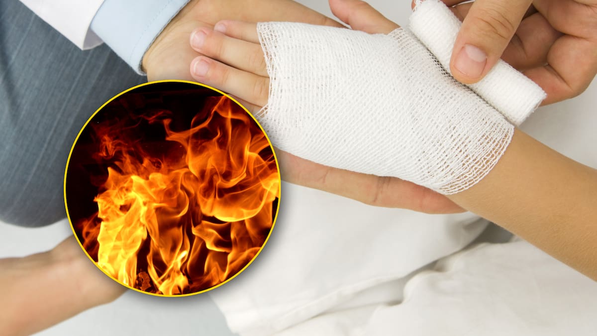 ¿Qué hacer en caso de una quemadura? Paso a paso para reaccionar, según experta