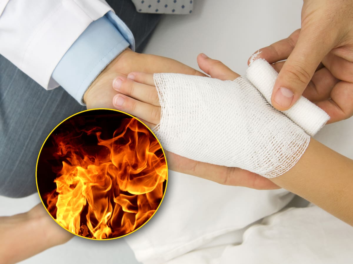 ¿Qué hacer en caso de una quemadura? Paso a paso para reaccionar, según experta