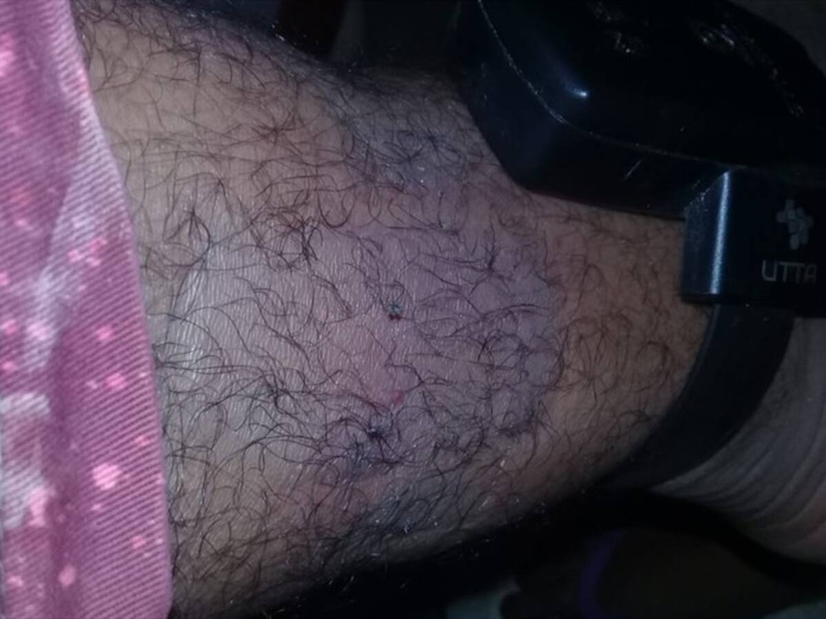 Detenidos con brazalete electrónico sufren quemaduras