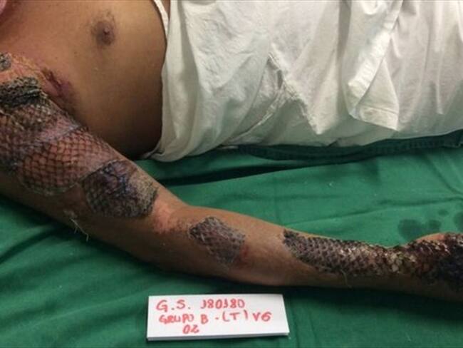 La piel del pescado se deja por varios días, dependiendo de la gravedad de las quemaduras. Foto: IJF, tomado de BBC Mundo.