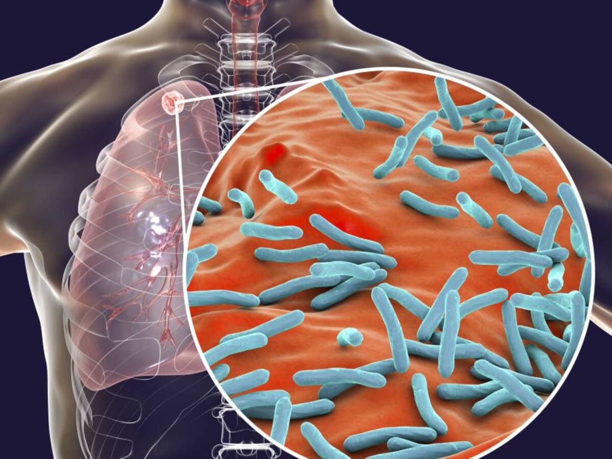 Alerta en Norte de Santander por aumento de casos de tuberculosis