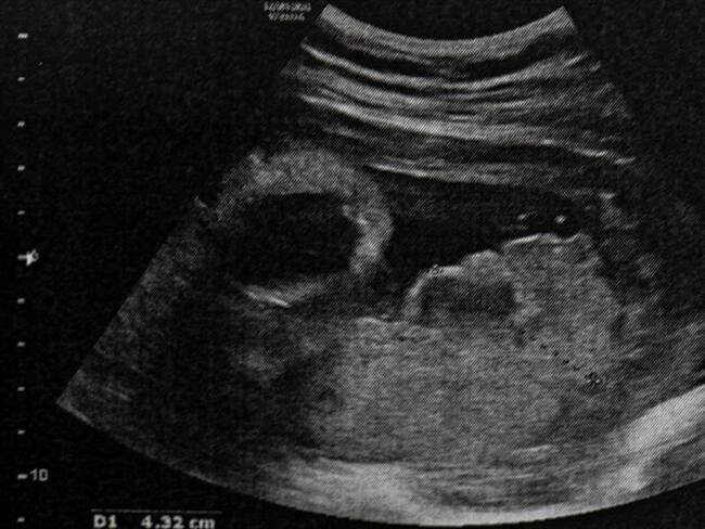 ¿Cómo afecta el aborto en la salud física y mental de las mujeres?