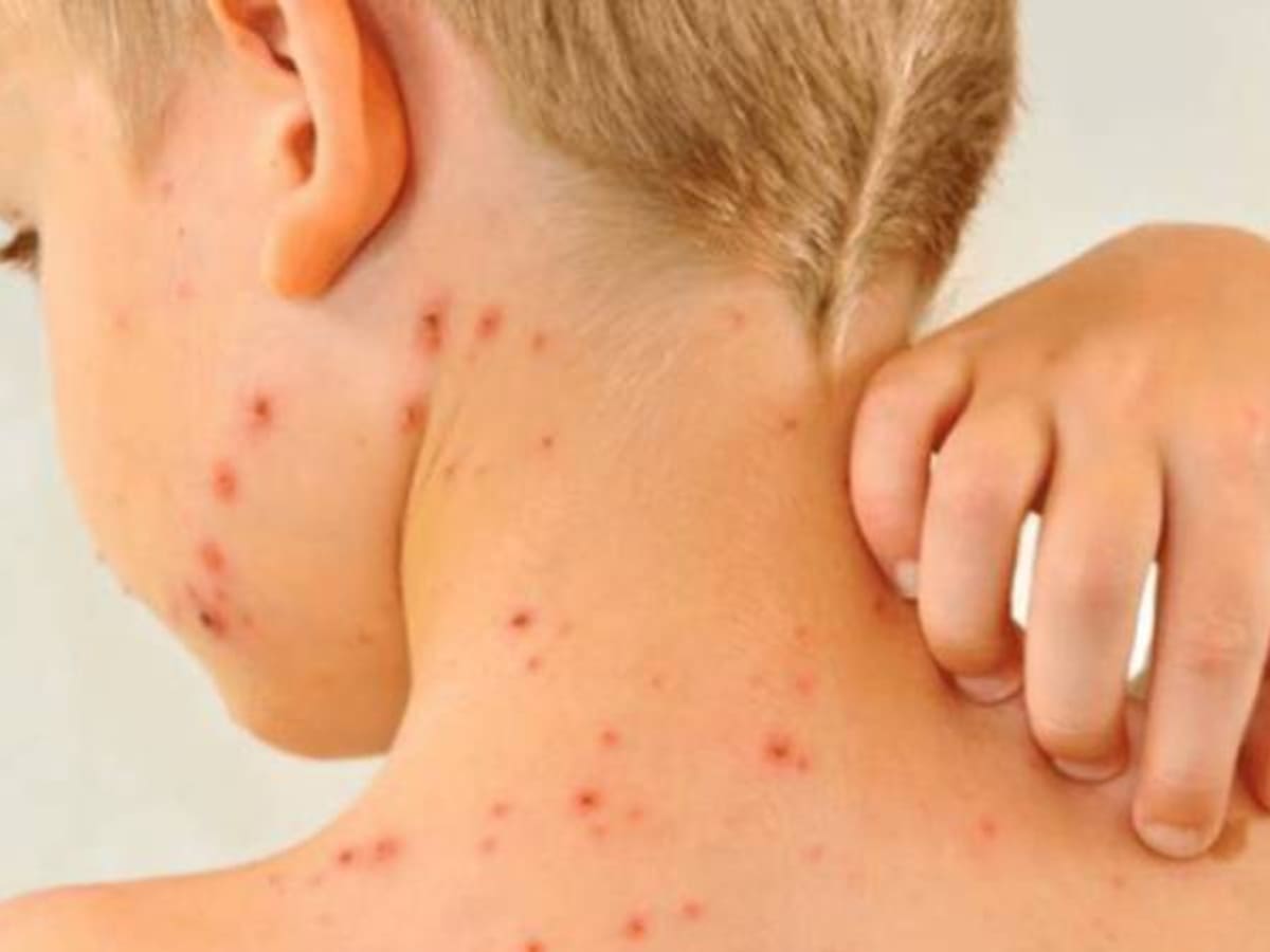 MinSalud emite circular con medidas para prevenir brotes de sarampión y rubéola de cara al Mundial