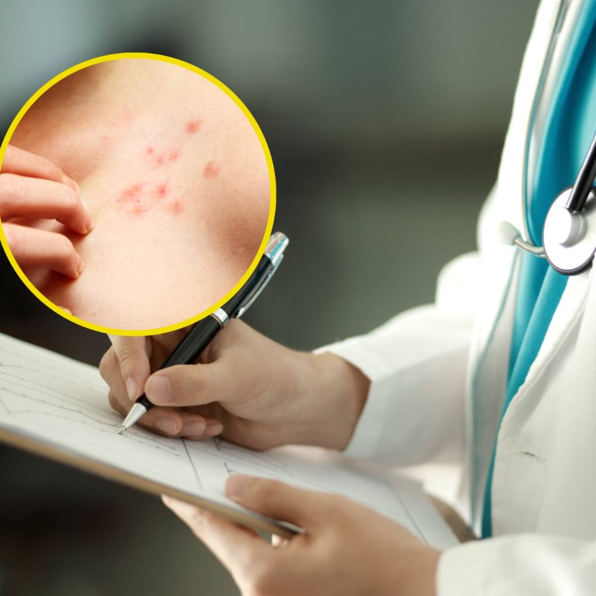 ¿Cómo identificar el herpes zóster o ‘culebrilla’? Experta explicó