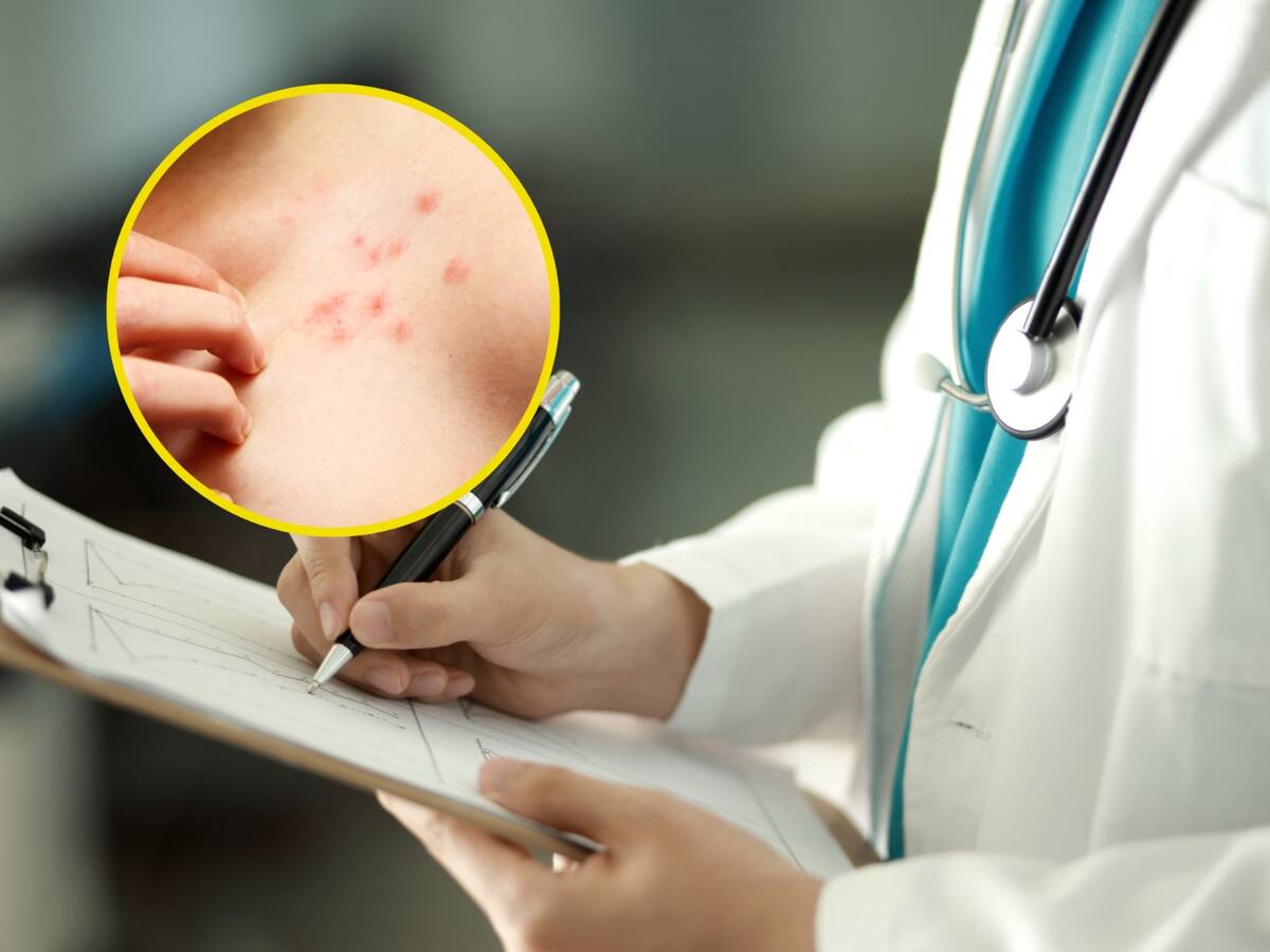 ¿Cómo identificar el herpes zóster o ‘culebrilla’? Experta explicó