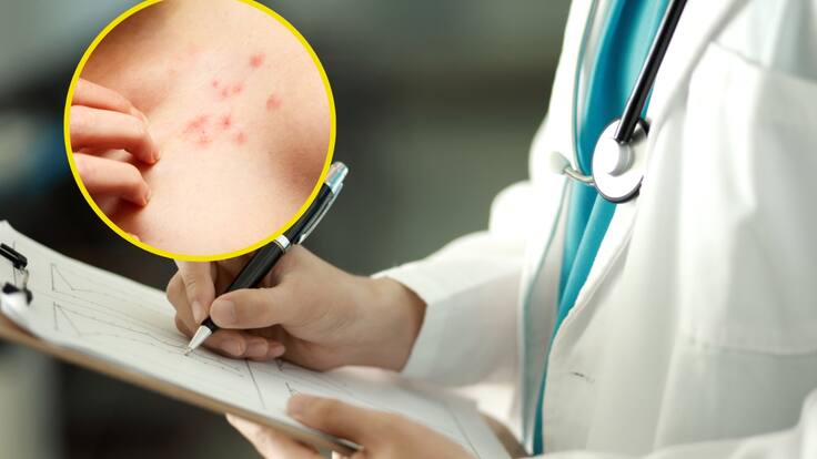 ¿Cómo identificar el Herpes Zóster o Culebrilla? Experta explicó