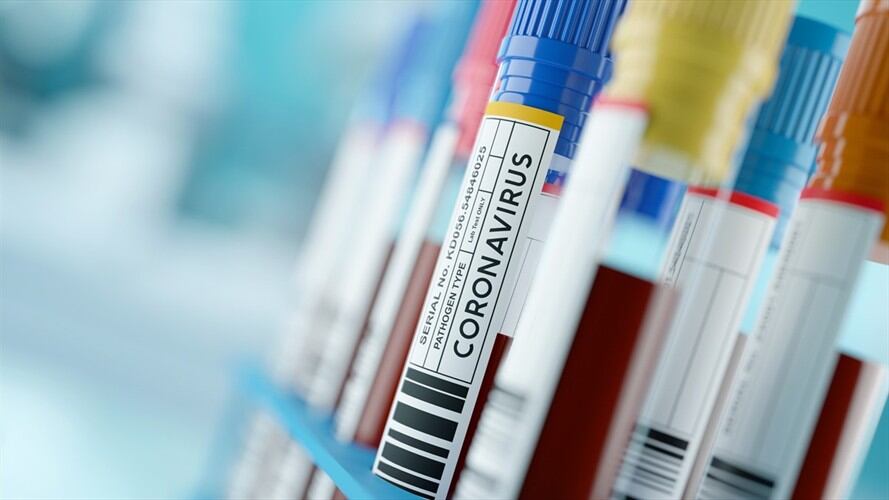 En Bogotá y 26 departamentos están represadas 15.053 pruebas para COVID-19 que no han sido procesadas. Foto: Getty Images