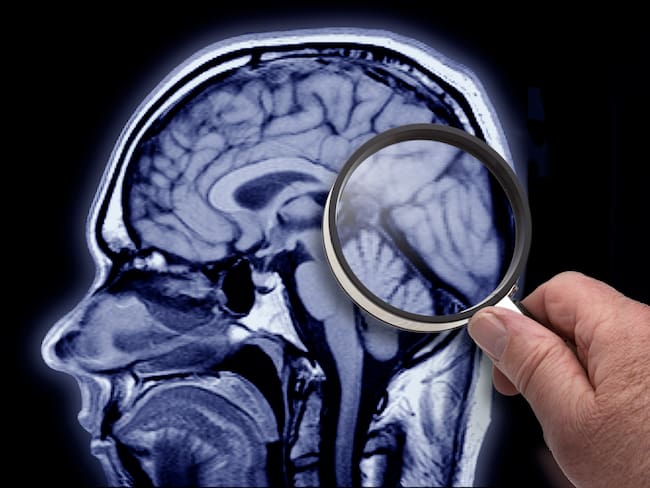 Imagen de referencia del Alzheimer. Foto: Getty Images