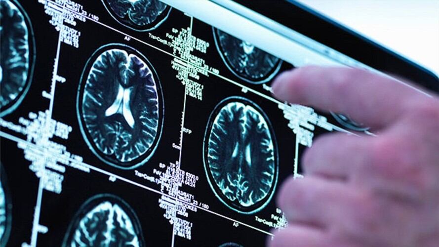 Un nuevo implante cerebral ayuda a mejorar la memoria a corto plazo. Foto: Bang Media
