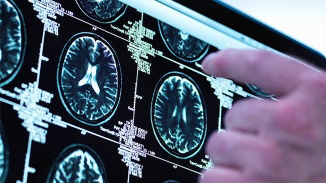 Un nuevo implante cerebral ayuda a mejorar la memoria a corto plazo. Foto: Bang Media