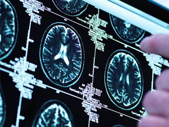Un nuevo implante cerebral ayuda a mejorar la memoria a corto plazo. Foto: Bang Media