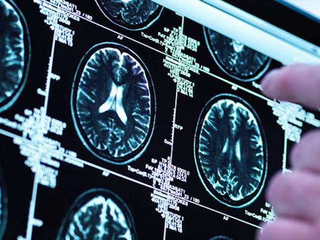 Un nuevo implante cerebral ayuda a mejorar la memoria a corto plazo. Foto: Bang Media