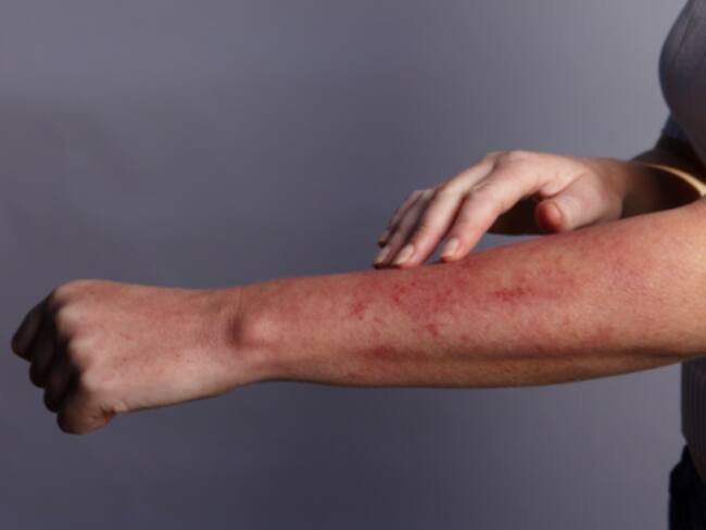 Mujer celosa quemó las partes íntimas a su pareja con agua hervida. Foto: Getty