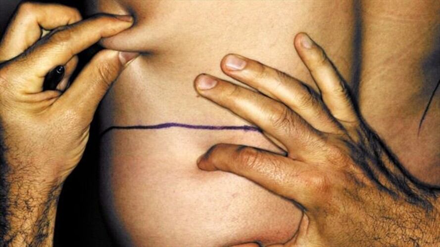 Una de cada cuatro cirugías estéticas entre los hombres de Estados Unidos es una liposucción.. Foto: Getty Images