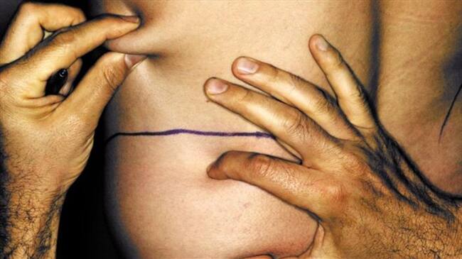 Una de cada cuatro cirugías estéticas entre los hombres de Estados Unidos es una liposucción.. Foto: Getty Images