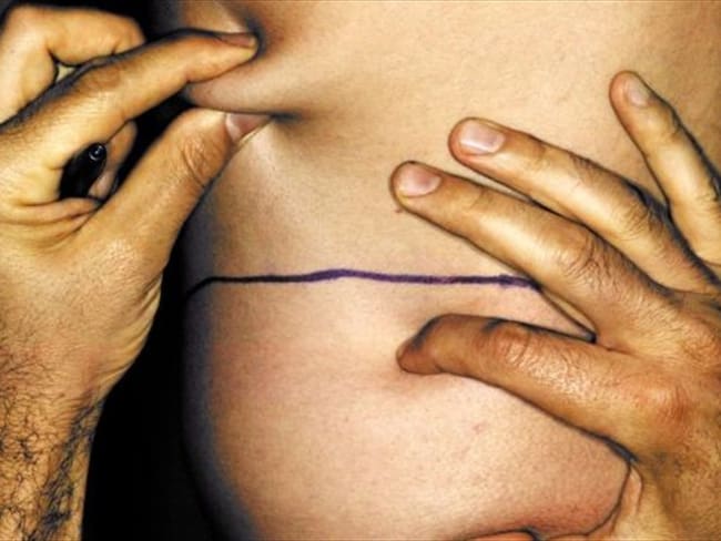 Una de cada cuatro cirugías estéticas entre los hombres de Estados Unidos es una liposucción.. Foto: Getty Images