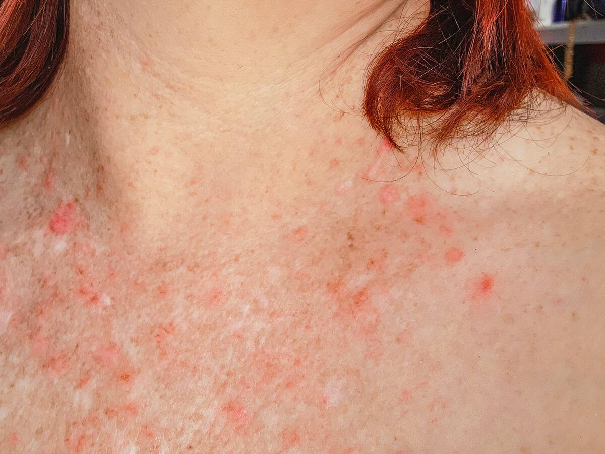 Dermatitis de contacto: sintomas, tratamiento y consejos