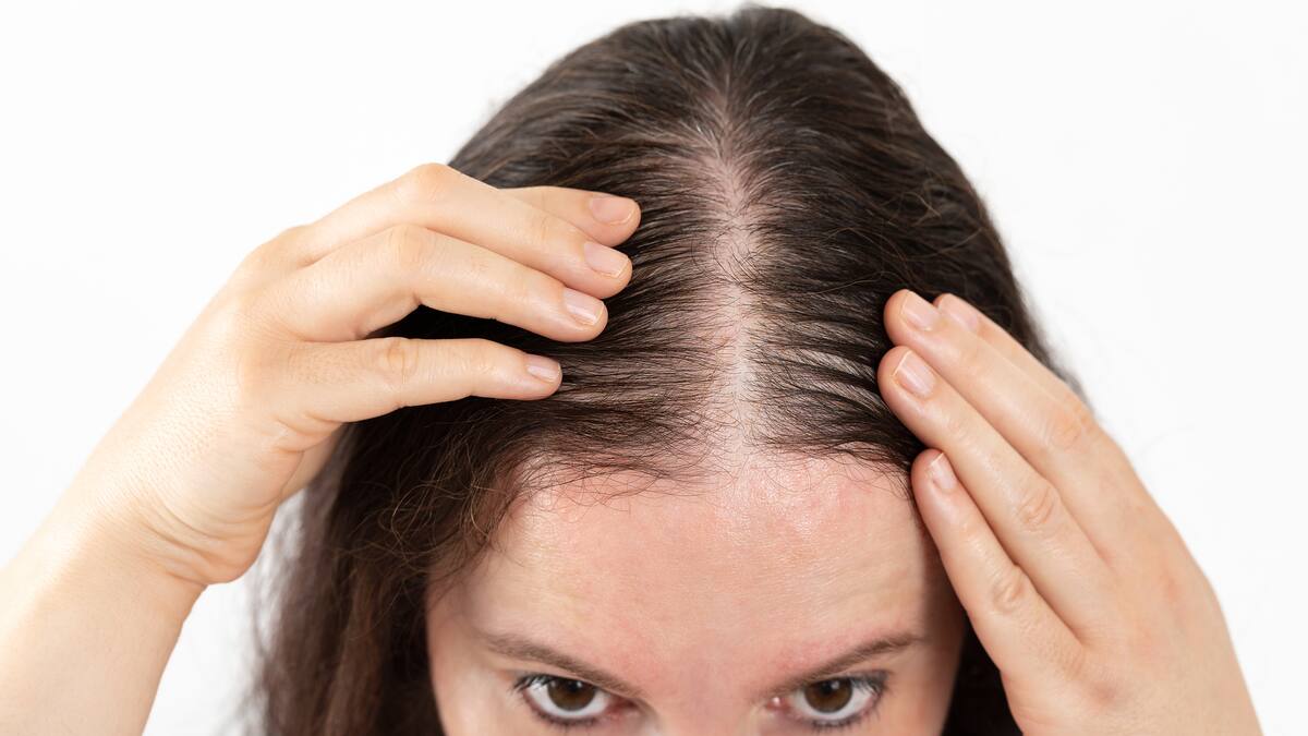¿Es genético el sufrir de alopecia? Experta explica cómo revertir la pérdida de cabello