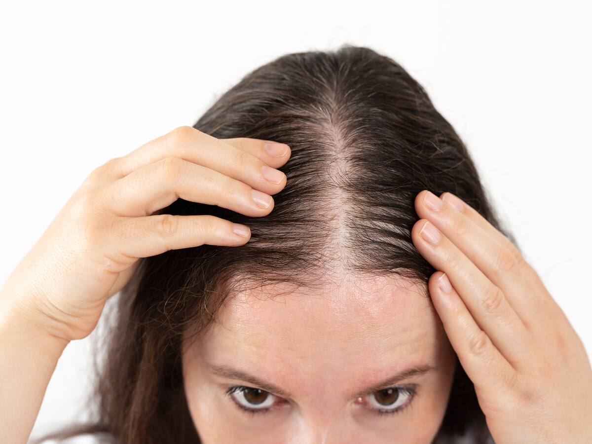 ¿Es genético el sufrir de alopecia? Experta explica cómo revertir la pérdida de cabello