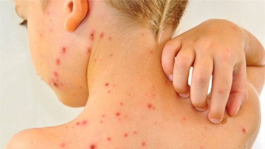 Sarampión en niños. Foto: Colprensa