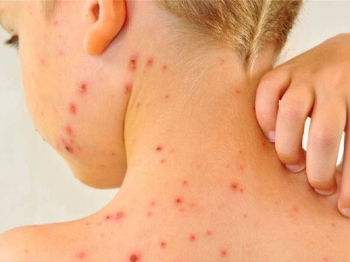 Amplían cerco epidemiológico en Tibú por un caso de sarampión confirmado