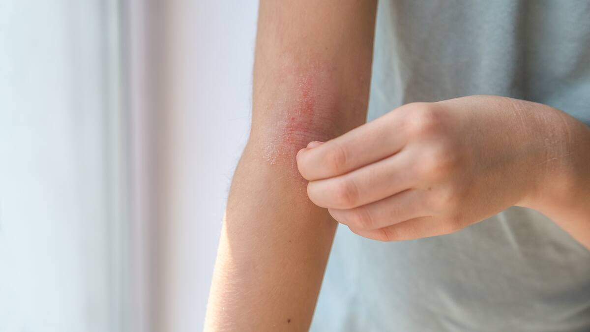 ¿Qué es la dermatitis atópica y cuáles son sus síntomas? Experta dio detalles
