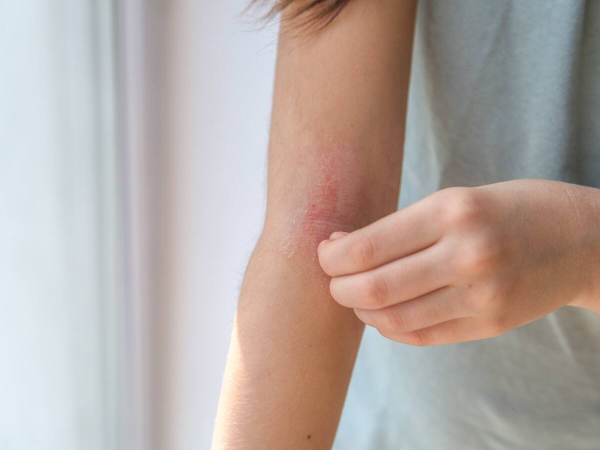¿Qué es la dermatitis atópica y cuáles son sus síntomas? Experta dio detalles