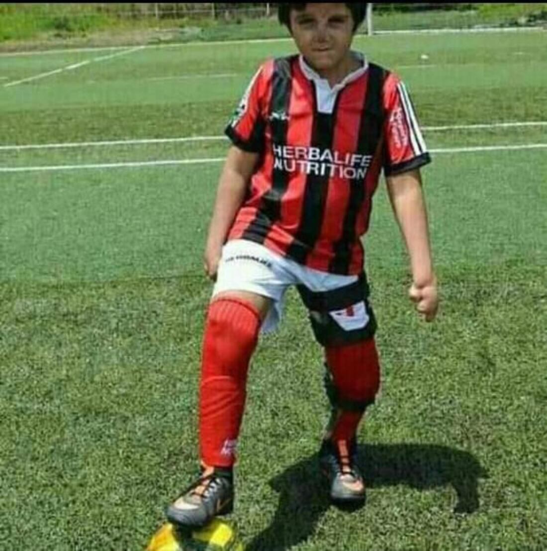 El menor requiere prótesis para movilizarse / Foto: Suministrada familia