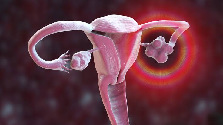 ¿Puede una mujer con ovario poliquístico quedar embarazada?