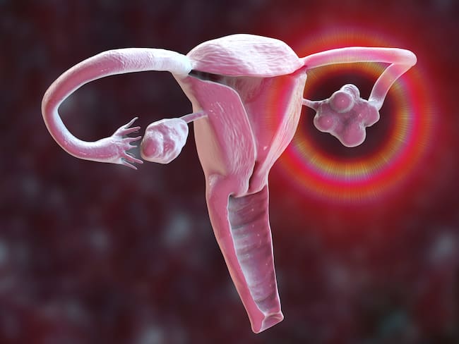 ¿Puede una mujer con ovario poliquístico quedar embarazada?